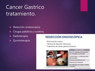 Cancer Gastrico
tratamiento.
 Resección endoscopica.
 Cirugia paliativa y curativa.
 Radioterapia.
 Quimioterapia.
 