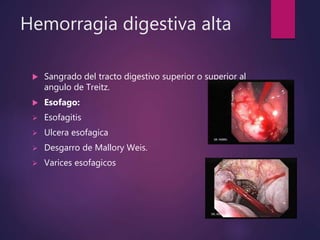 Hemorragia digestiva alta
 Sangrado del tracto digestivo superior o superior al
angulo de Treitz.
 Esofago:
 Esofagitis
 Ulcera esofagica
 Desgarro de Mallory Weis.
 Varices esofagicos
 