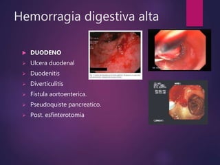 Hemorragia digestiva alta
 DUODENO
 Ulcera duodenal
 Duodenitis
 Diverticulitis
 Fistula aortoenterica.
 Pseudoquiste pancreatico.
 Post. esfinterotomia
 