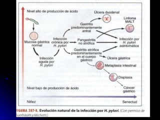 ULCERA PEPTICA Gatrica - Medicina pregrado