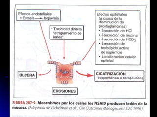 ULCERA PEPTICA Gatrica - Medicina pregrado