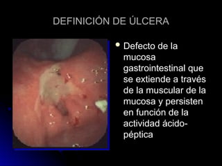 DEFINICIÓN DE ÚLCERA
DEFINICIÓN DE ÚLCERA
 Defecto de la
Defecto de la
mucosa
mucosa
gastrointestinal que
gastrointestinal que
se extiende a través
se extiende a través
de la muscular de la
de la muscular de la
mucosa y persisten
mucosa y persisten
en función de la
en función de la
actividad ácido-
actividad ácido-
péptica
péptica
 