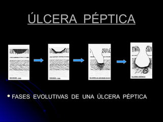 ÚLCERA PÉPTICA
ÚLCERA PÉPTICA
 FASES EVOLUTIVAS DE UNA ÚLCERA PÉPTICA
FASES EVOLUTIVAS DE UNA ÚLCERA PÉPTICA
 