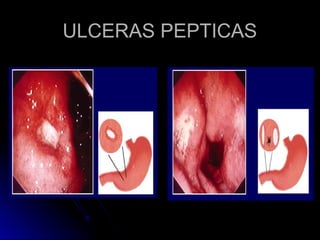 ULCERAS PEPTICAS
ULCERAS PEPTICAS
 