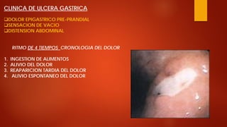 CLINICA DE ULCERA GASTRICA 
 
DOLOR EPIGASTRICO PRE-PRANDIAL 
 
SENSACION DE VACIO 
 
DISTENSION ABDOMINAL RITMO DE 4 TIEMPOS CRONOLOGIA DEL DOLOR 
1. 
INGESTION DE ALIMENTOS 
2. 
ALIVIO DEL DOLOR 
3. 
REAPARICION TARDIA DEL DOLOR 
4. 
ALIVIO ESPONTANEO DEL DOLOR  