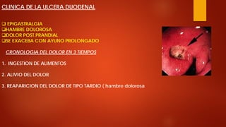CLINICA DE LA ULCERA DUODENAL 
 
EPIGASTRALGIA 
 
HAMBRE DOLOROSA 
 
DOLOR POST.PRANDIAL 
 
SE EXACEBA CON AYUNO PROLONGADO CRONOLOGIA DEL DOLOR EN 3 TIEMPOS 
1. 
INGESTION DE ALIMENTOS 2. ALIVIO DEL DOLOR 3. REAPARICION DEL DOLOR DE TIPO TARDIO ( hambre dolorosa  