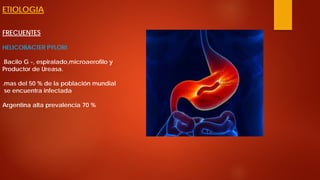 ETIOLOGIA FRECUENTES HELICOBACTER PYLORI .Bacilo G -, espiralado,microaerofilo y Productor de Ureasa. .mas del 50 % de la población mundial se encuentra infectada Argentina alta prevalencia 70 %  