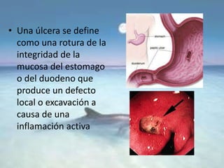 • Una úlcera se define
como una rotura de la
integridad de la
mucosa del estomago
o del duodeno que
produce un defecto
local o excavación a
causa de una
inflamación activa
 