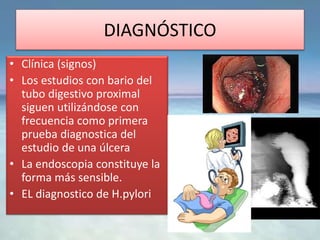 DIAGNÓSTICO
• Clínica (signos)
• Los estudios con bario del
tubo digestivo proximal
siguen utilizándose con
frecuencia como primera
prueba diagnostica del
estudio de una úlcera
• La endoscopia constituye la
forma más sensible.
• EL diagnostico de H.pylori
 