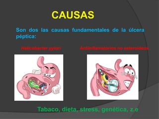 CAUSAS
Son dos las causas fundamentales de la úlcera
péptica:

 Helicobacter pylori   Antiinflamatorios no esteroideos




        Tabaco, dieta, stress, genética, z.e
 