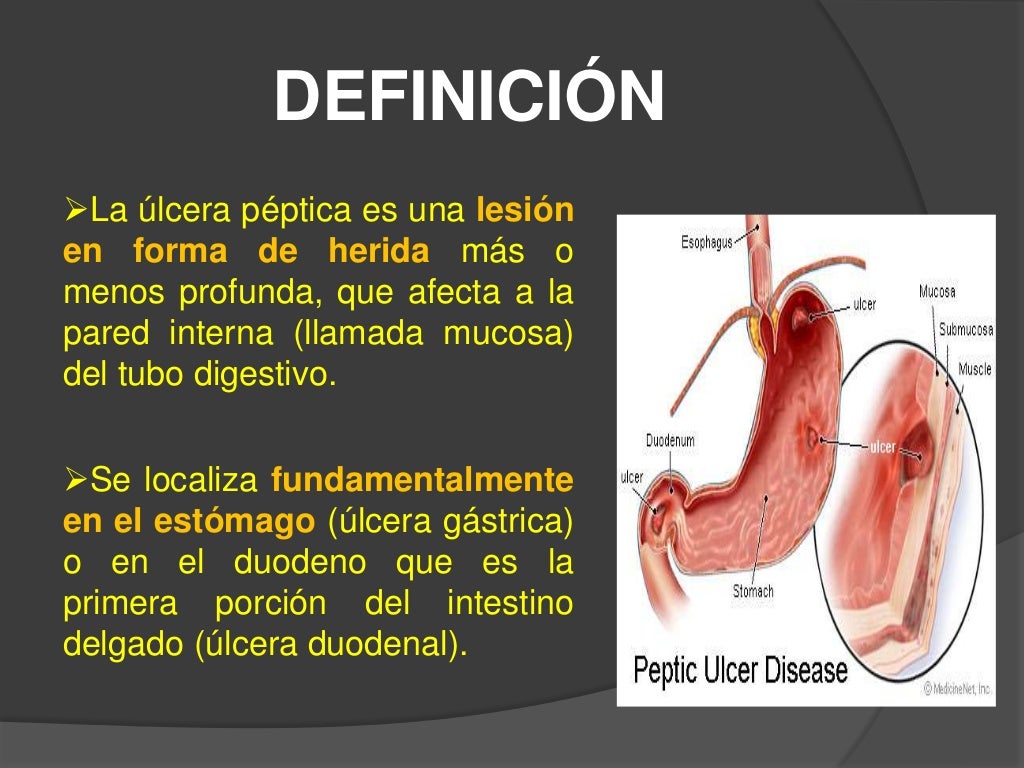 Ulcera Peptica Causas _ Úlcera péptica: Causas, síntomas y tratamiento ...
