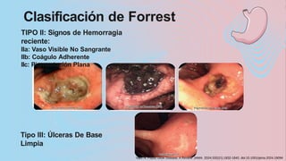 ULCERA PEPTICA definiciones y bases cientificas.pptx