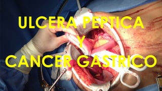 ULCERA PEPTICA
Y
CANCER GASTRICO

 