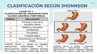 Ulcera peptida perforada | PPTX