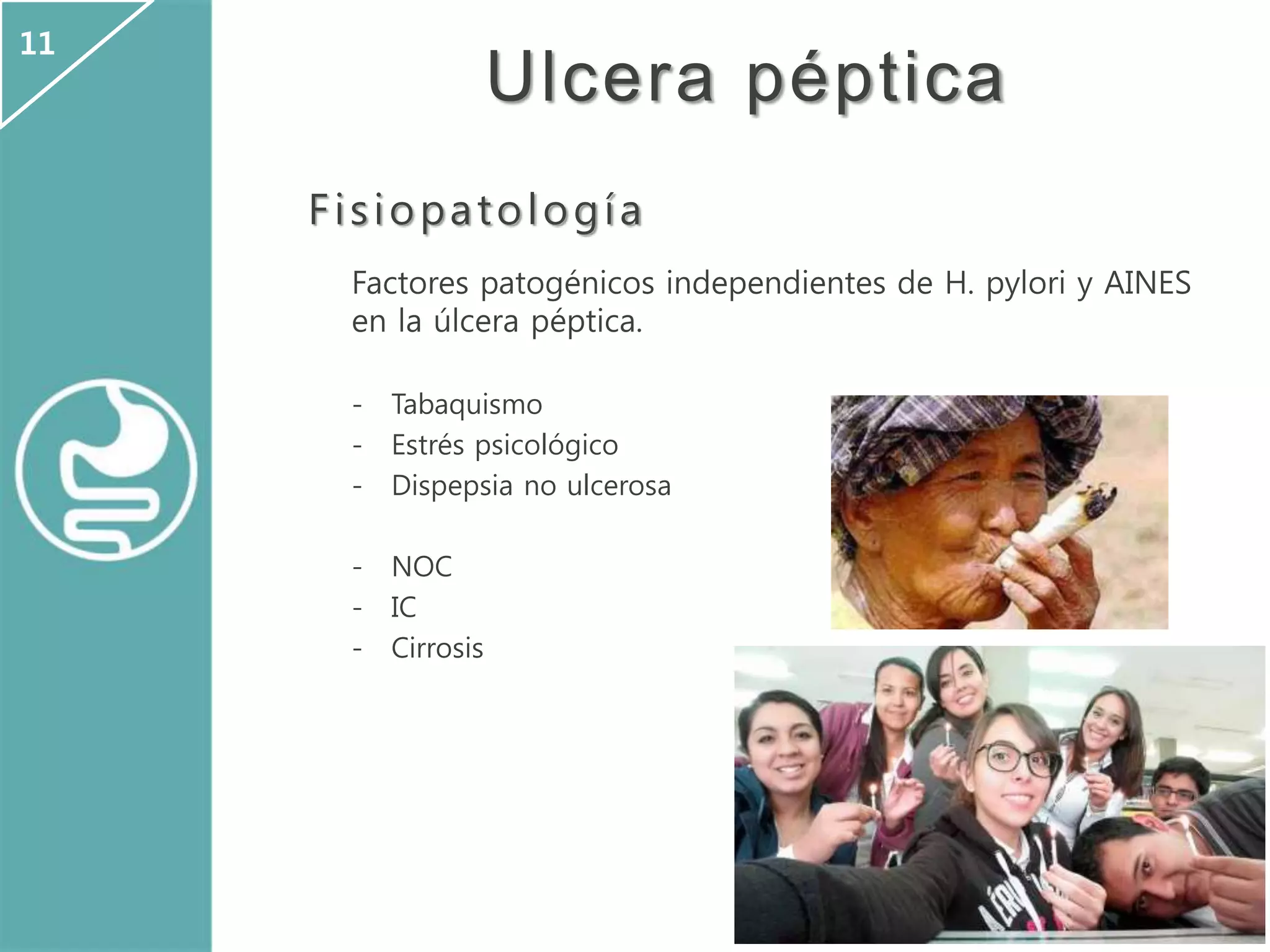 Ulcera péptica
Fisiopatología
Factores patogénicos independientes de H. pylori y AINES
en la úlcera péptica.
- Tabaquismo
- Estrés psicológico
- Dispepsia no ulcerosa
- NOC
- IC
- Cirrosis
11
 