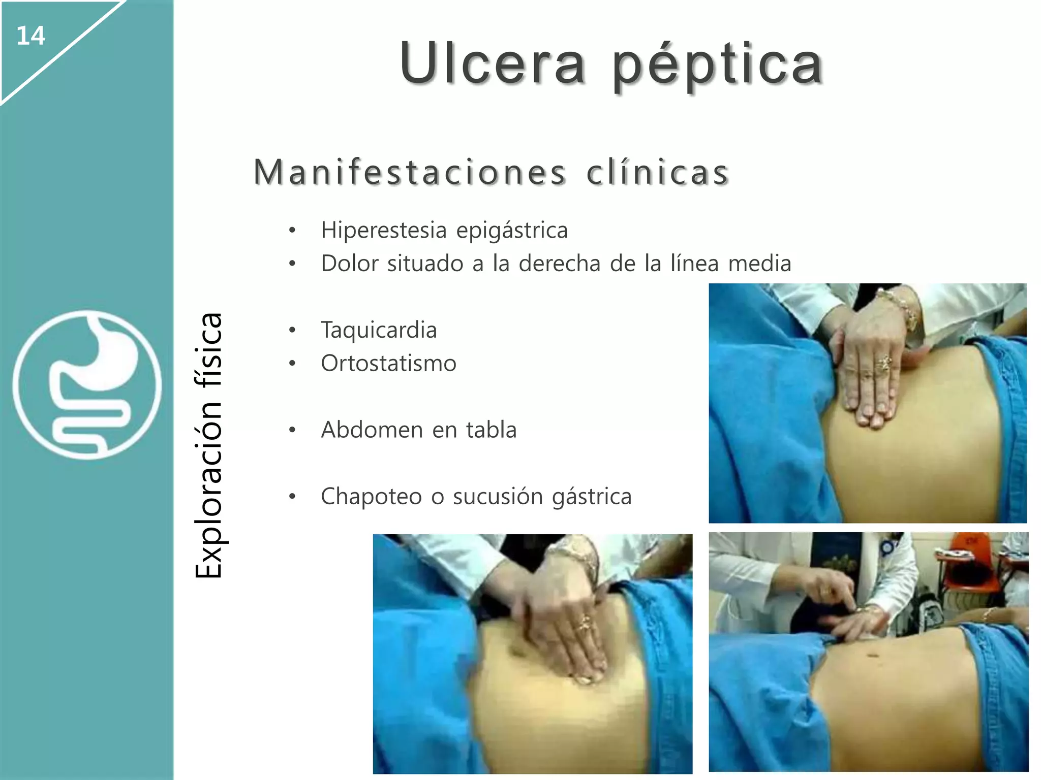 Ulcera péptica
Manifestaciones clínicas
• Hiperestesia epigástrica
• Dolor situado a la derecha de la línea media
• Taquicardia
• Ortostatismo
• Abdomen en tabla
• Chapoteo o sucusión gástrica
Exploraciónfísica
14
 
