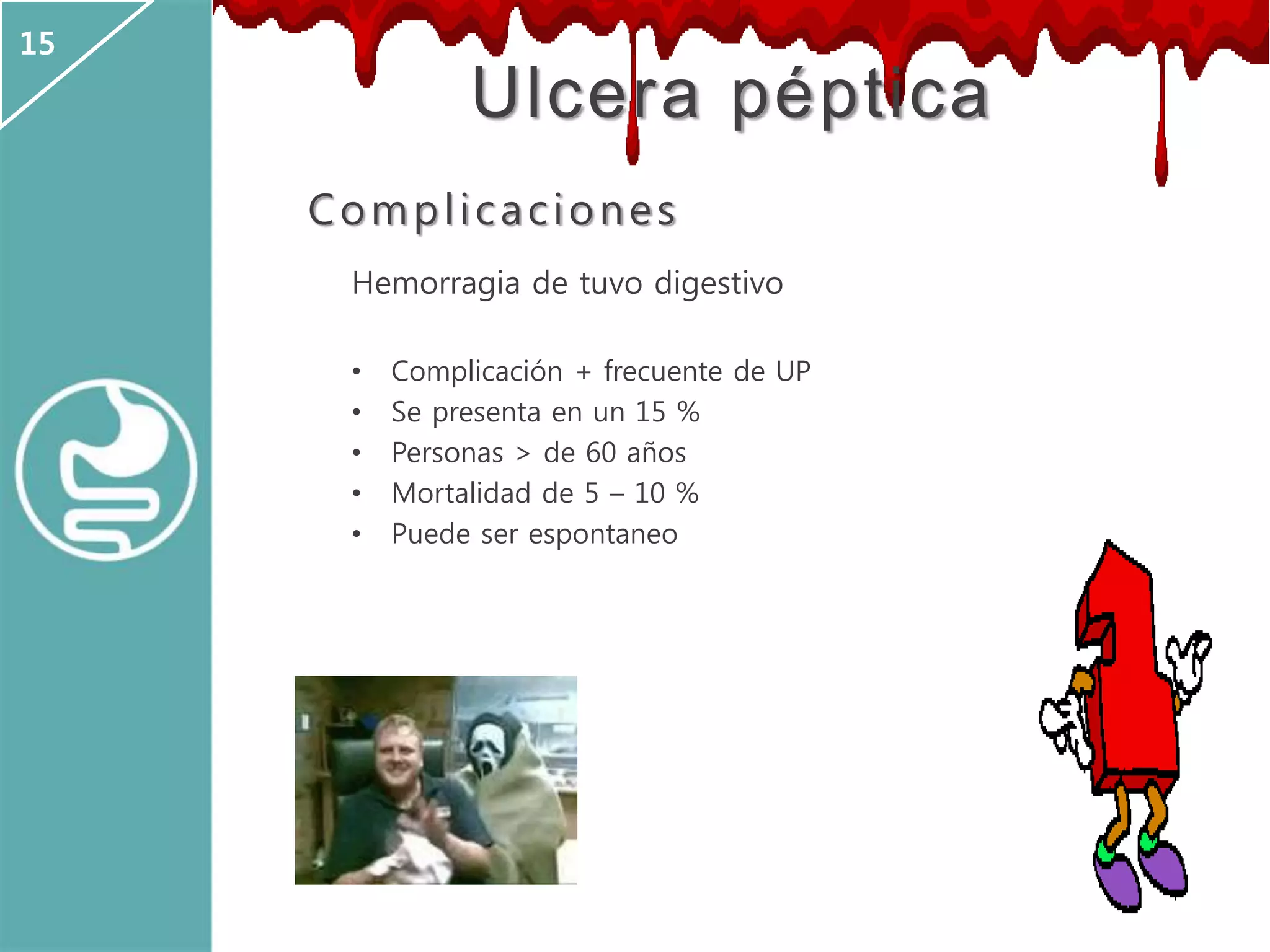 Ulcera péptica
Complicaciones
Hemorragia de tuvo digestivo
• Complicación + frecuente de UP
• Se presenta en un 15 %
• Personas > de 60 años
• Mortalidad de 5 – 10 %
• Puede ser espontaneo
15
 