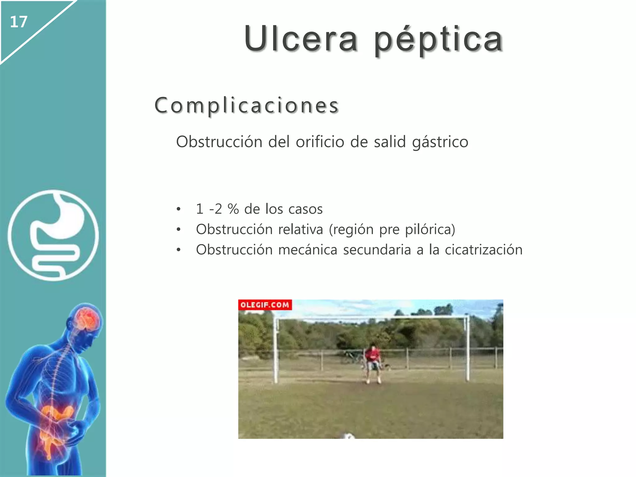 Ulcera péptica
Complicaciones
Obstrucción del orificio de salid gástrico
• 1 -2 % de los casos
• Obstrucción relativa (región pre pilórica)
• Obstrucción mecánica secundaria a la cicatrización
17
 