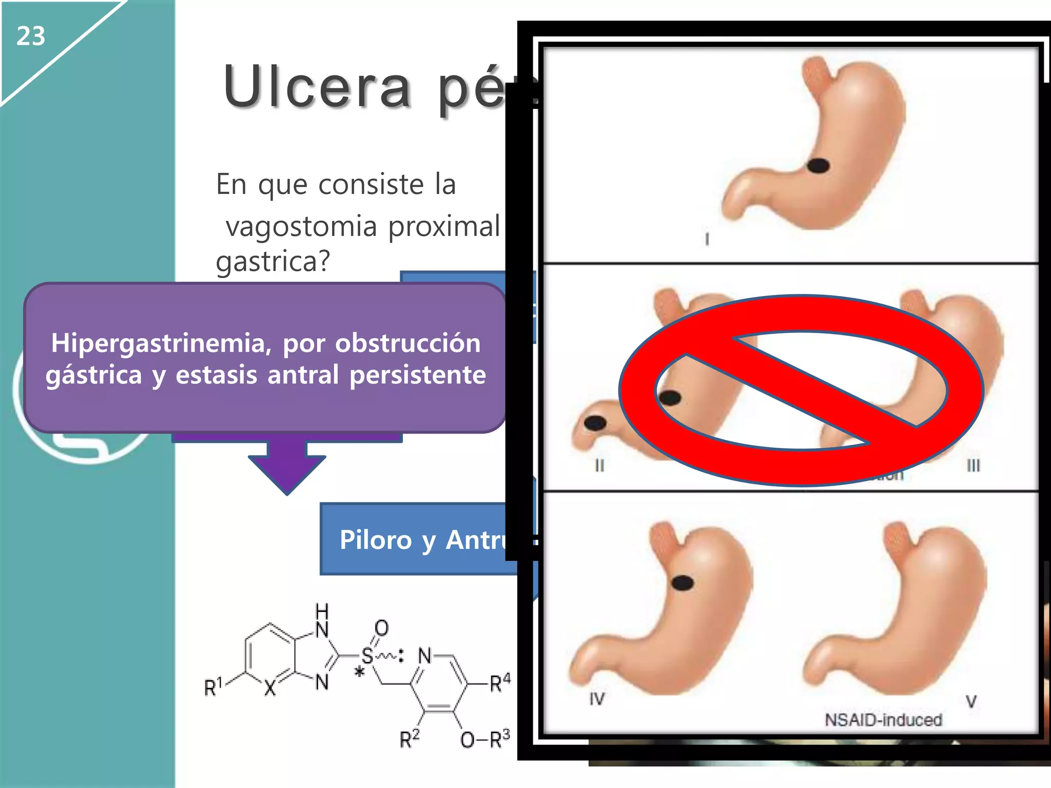 En que consiste la
vagostomia proximal
gastrica?
Ulcera péptica
C. Parietales
Piloro y Antrum
75% HCO3
Hipergastrinemia, por obstrucción
gástrica y estasis antral persistente
23
 