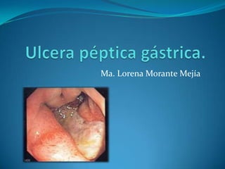 Ulcera péptica gástrica.<br />Ma. Lorena Morante Mejía<br />