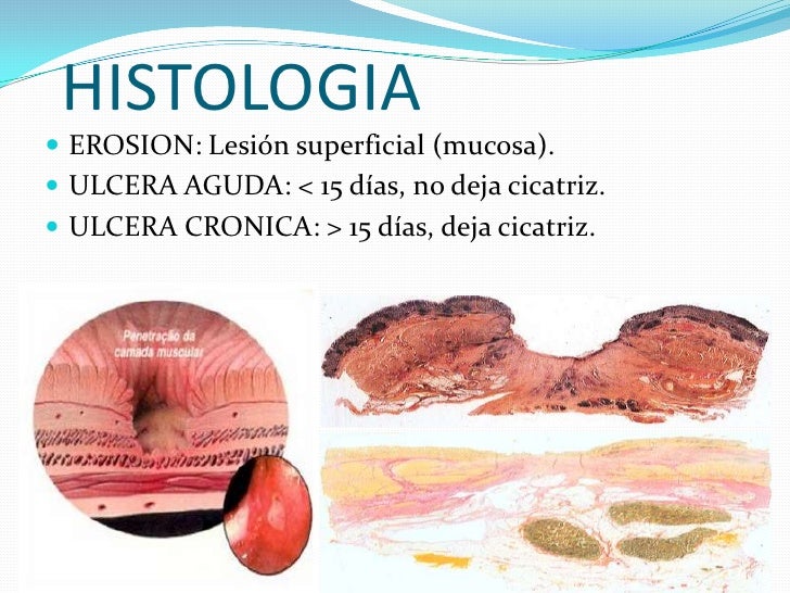 Frammenti Di Mucosa Gastrica Di Tipo Antrale E Fundico