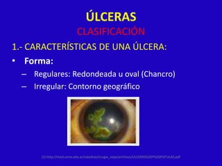 ÚLCERAS
                            CLASIFICACIÓN
1.- CARACTERÍSTICAS DE UNA ÚLCERA:
• Forma:
  – Regulares: Redondeada u oval (Chancro)
  – Irregular: Contorno geográfico




       (1) http://med.unne.edu.ar/catedras/cirugia_viejo/archivos/ULCERAS%20Y%20FISTULAS.pdf
 