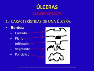 ÚLCERAS
                            CLASIFICACIÓN
1.- CARACTERÍSTICAS DE UNA ÚLCERA:
• Bordes:
  –   Cortado
  –   Plano
  –   Infiltrado
  –   Vegetante
  –   Policíclico


       (1) http://med.unne.edu.ar/catedras/cirugia_viejo/archivos/ULCERAS%20Y%20FISTULAS.pdf
 
