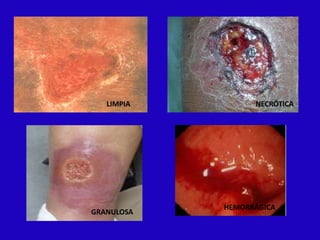 LIMPIA         NECRÓTICA




            HEMORRÁGICA
GRANULOSA
 