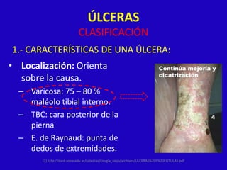 ÚLCERAS
                             CLASIFICACIÓN
1.- CARACTERÍSTICAS DE UNA ÚLCERA:
• Localización: Orienta
  sobre la causa.
  – Varicosa: 75 – 80 %
    maléolo tibial interno.
  – TBC: cara posterior de la
    pierna
  – E. de Raynaud: punta de
    dedos de extremidades.
        (1) http://med.unne.edu.ar/catedras/cirugia_viejo/archivos/ULCERAS%20Y%20FISTULAS.pdf
 