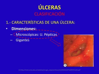 ÚLCERAS
                           CLASIFICACIÓN
1.- CARACTERÍSTICAS DE UNA ÚLCERA:
• Dimensiones:
  – Microscópicas: U. Pépticas
  – Gigantes




      (1) http://med.unne.edu.ar/catedras/cirugia_viejo/archivos/ULCERAS%20Y%20FISTULAS.pdf
 