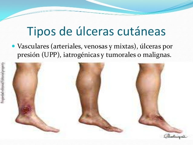 Resultado de imagen para tipos de ulcera cutanea