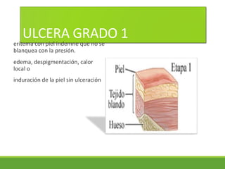 ULCERA GRADO 1
eritema con piel indemne que no se
blanquea con la presión.
edema, despigmentación, calor
local o
induración de la piel sin ulceración
 