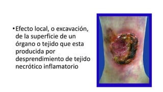 Ulceras.pptx