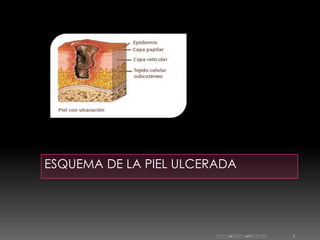 ESQUEMA DE LA PIEL ULCERADA




                        10/11/2011   5
 
