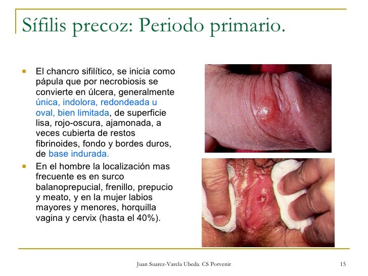 Ulceras anogenitales.ud4