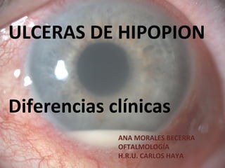 ULCERAS DE HIPOPION
Diferencias clínicas
ANA MORALES BECERRA
OFTALMOLOGÍA
H.R.U. CARLOS HAYA
 