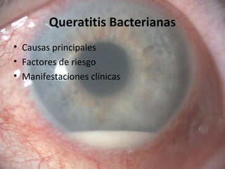 Queratitis Bacterianas
• Causas principales
• Factores de riesgo
• Manifestaciones clínicas
 