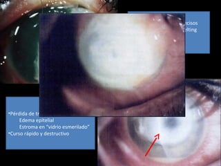 •Ulceras de bordes imprecisos
•Aspecto caseificado “melting
corneal”
•Mal delimitada
•Pérdida de transparencia corneal
Edema epitelial
Estroma en “vidrio esmerilado”
•Curso rápido y destructivo
 