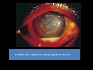 Infiltrados como cabezas de alfiler (configuración en pétalo)
 
