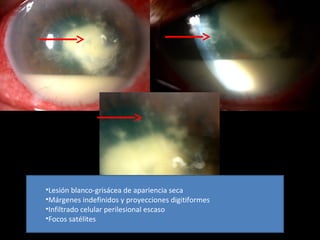 •Lesión blanco-grisácea de apariencia seca
•Márgenes indefinidos y proyecciones digitiformes
•Infiltrado celular perilesional escaso
•Focos satélites
 