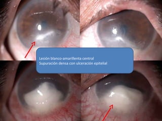 Lesión blanco-amarillenta central
Supuración densa con ulceración epitelial
 
