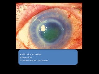 •Infiltrados en anillos
•Ulceración
•Uveítis anterior más severa.
 