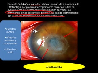 Paciente de 24 años, nadador habitual, que acude a Urgencias de
Oftalmología por presentar enrojecimiento ocular de 9 días de
evolución con dolor importante y disminución de visión. Es
portador de lentes de contacto blandas. Ha estado en tratamiento
con colirio de Tobramicina sin experimentar mejoría.
Acanthamoeba
•Queratitis
puntata
•Infiltrados
epiteliales y
subepiteliales
•Infiltrado en
anillo
 