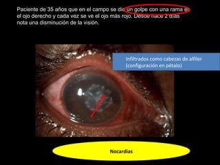 Paciente de 35 años que en el campo se dio un golpe con una rama en
el ojo derecho y cada vez se ve el ojo más rojo. Desde hace 2 días
nota una disminución de la visión.
Nocardias
Infiltrados como cabezas de alfiler
(configuración en pétalo)
 