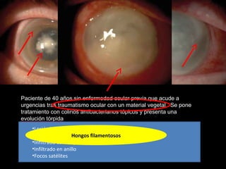 Paciente de 40 años sin enfermedad ocular previa que acude a
urgencias tras traumatismo ocular con un material vegetal . Se pone
tratamiento con colirios antibacterianos tópicos y presenta una
evolución tórpida
•Lesión blanco-grisácea de apariencia seca
•Márgenes indefinidos y proyecciones digitiformes
•Infiltrado celular perilesional escaso
•Infiltrado en anillo
•Focos satélites
Hongos filamentosos
 