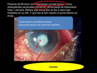 Paciente de 60 años con enfermedad corneal previa . Como
antecedentes personales Leucemia, última pauta de tratamiento
hace 1 semana. Refiere que desde que se fue a casa nota
molestias en su OD. Y que hoy le han notado un punto blanco en
el ojo.
Cándida
Lesión blanco-amarillenta central
Supuración densa con ulceración epitelial
 