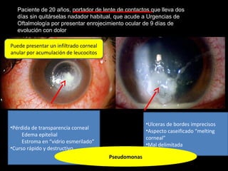 Paciente de 20 años, portador de lente de contactos que lleva dos
días sin quitárselas nadador habitual, que acude a Urgencias de
Oftalmología por presentar enrojecimiento ocular de 9 días de
evolución con dolor
•Ulceras de bordes imprecisos
•Aspecto caseificado “melting
corneal”
•Mal delimitada
•Pérdida de transparencia corneal
Edema epitelial
Estroma en “vidrio esmerilado”
•Curso rápido y destructivo
Pseudomonas
Puede presentar un infiltrado corneal
anular por acumulación de leucocitos
 