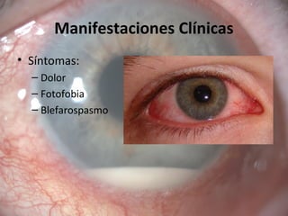Manifestaciones Clínicas
• Síntomas:
– Dolor
– Fotofobia
– Blefarospasmo
 