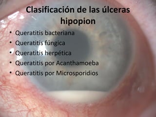 Clasificación de las úlceras
hipopion
• Queratitis bacteriana
• Queratitis fúngica
• Queratitis herpética
• Queratitis por Acanthamoeba
• Queratitis por Microsporidios
 