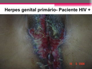 Herpes genital primário- Paciente HIV +

 